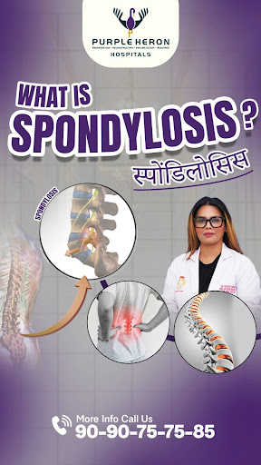 WHAT IS SPONDYLOSIS?
Spondylosis is a degenerative condition