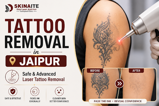 Tattoo Removal in Jaipur | Safe & Advanced Laser Tattoo Remo
