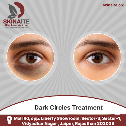 Say Goodbye to Dark Circles with Skinaite Clinic! ✨

Are dar