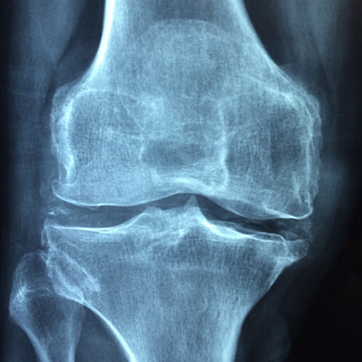 Physical therapy for knee Osteoarthritis 

Attention all ind