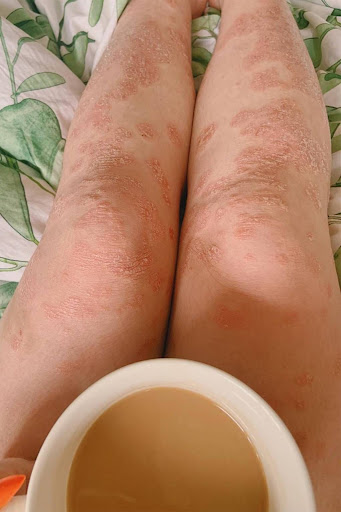 Living with severe skin inflammation or scaling patches? Pso