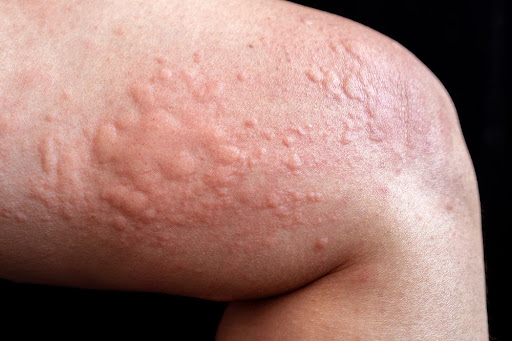 Suffering from skin rashes, hives, or chronic skin allergies
