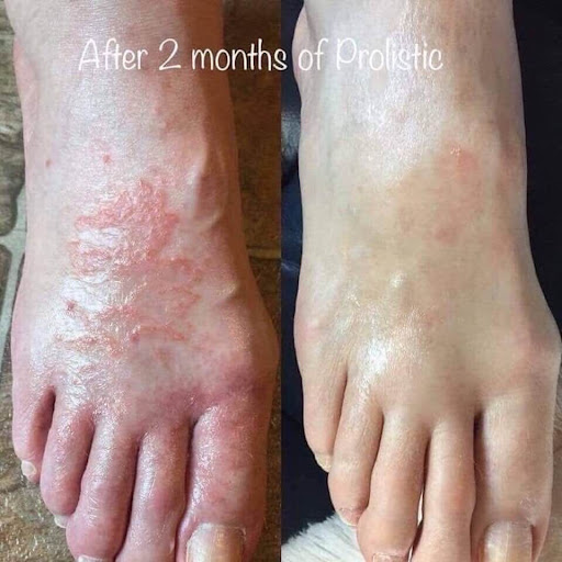 Experience visible skin transformation with Prolistic! This 