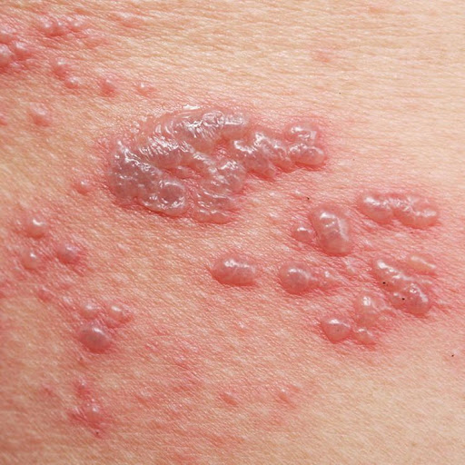 Struggling with painful skin rashes or fluid-filled blisters