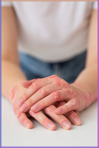 Sooth and heal dry, irritated, or scaling skin conditions wi