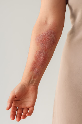 Kya aapki skin par bhi red, scaly patches ya rash dikh rahe 