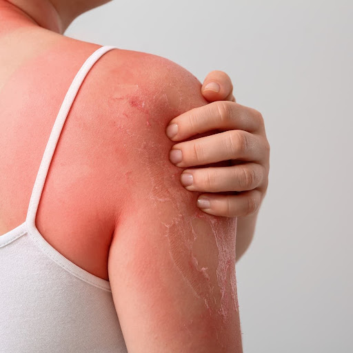 Soothe and repair sun-damaged skin with professional dermato