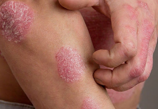 Say goodbye to persistent skin redness, scaling, and irritat