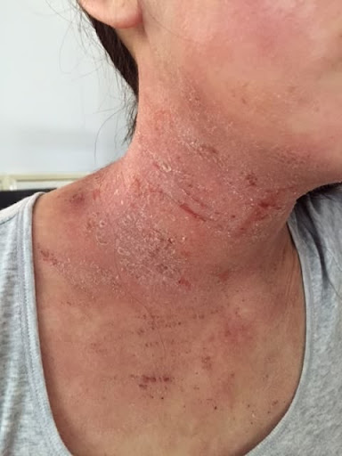 Kya aapki skin par redness, irritation, ya severe peeling ki
