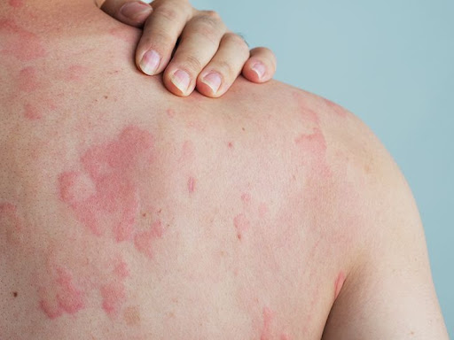 Dealing with sudden skin rashes, hives, or persistent itchin
