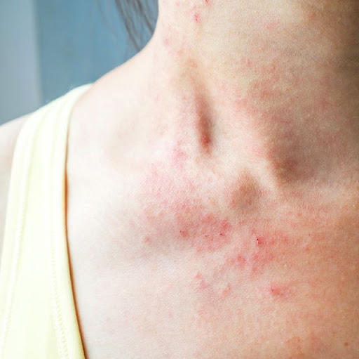Don't let skin allergies, rashes, or irritation disrupt your