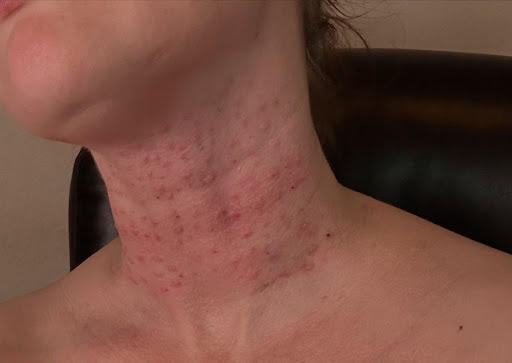 Experiencing skin irritation, redness, or rashes on your nec