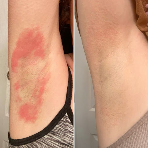 Expert skin allergy and rash care in Jaipur. Get professiona
