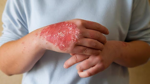 Dealing with severe skin flare-ups, chronic rashes, or painf