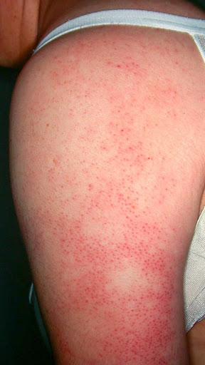 Are you experiencing persistent skin rashes, irritation, or 