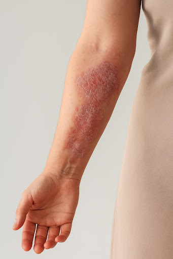 Red, itchy, scaly skin patches? Get expert dermatology care 