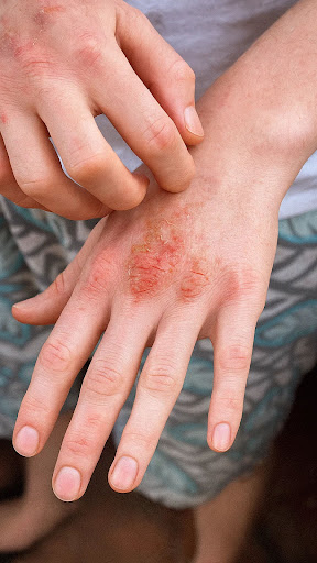 Are dry skin, severe itching, eczema, or skin rashes troubli