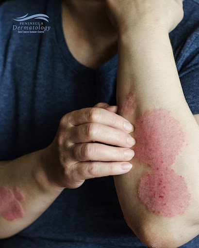 Red, raised, scaly patches on your skin can be a sign of con