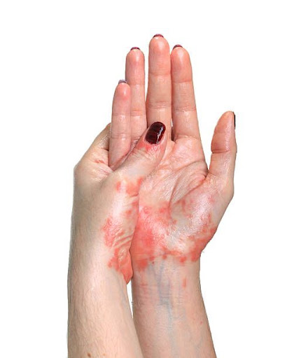 Experiencing red, itchy, dry, or peeling skin on your hands?