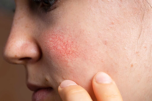 Chehre par lagatar lalipan ya dikhne wali naso (spider veins