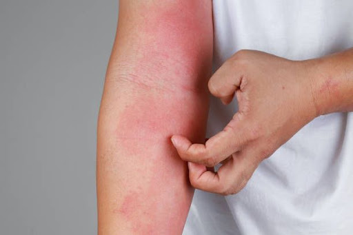 Red, itchy, irritated skin can be uncomfortable and frustrat