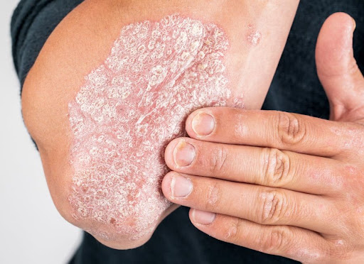 Struggling with scaly, itchy skin patches? It could be psori