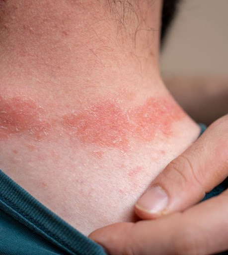 Dealing with persistent skin redness, itching, or rash? 🛑✨ 