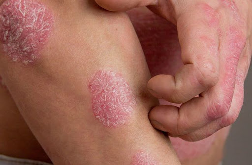 Expert Psoriasis Treatment in Jaipur for managing dry, itchy