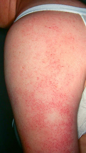 Don't ignore persistent rashes or skin irritation! Get exper
