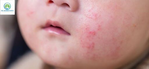Child Skin Allergy Treatment by Trusted Specialists in Jaipur