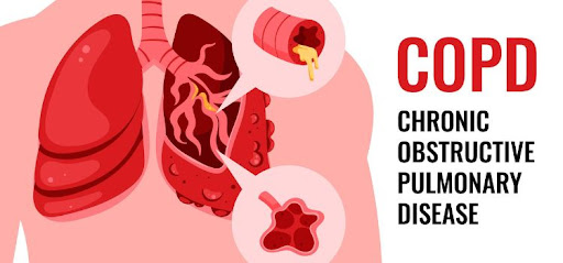 COPD Treatment in Jaipur – Chronic Cough Ko Ignore Na Karein