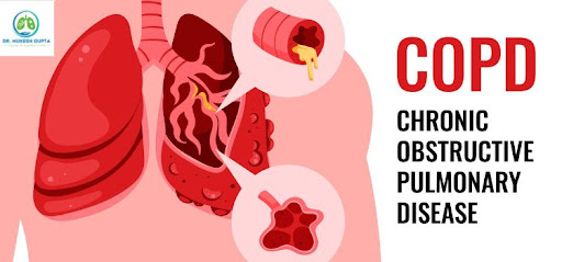 COPD & Chronic Cough — 5 Sawaal जो हर मरीज़ पूछता है!